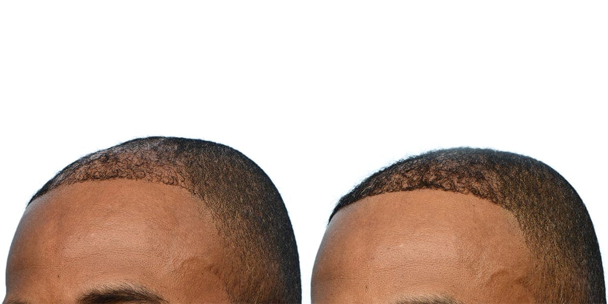 FUE Hair Transplant Before & After Gallery - Patient 279403 - Image 4