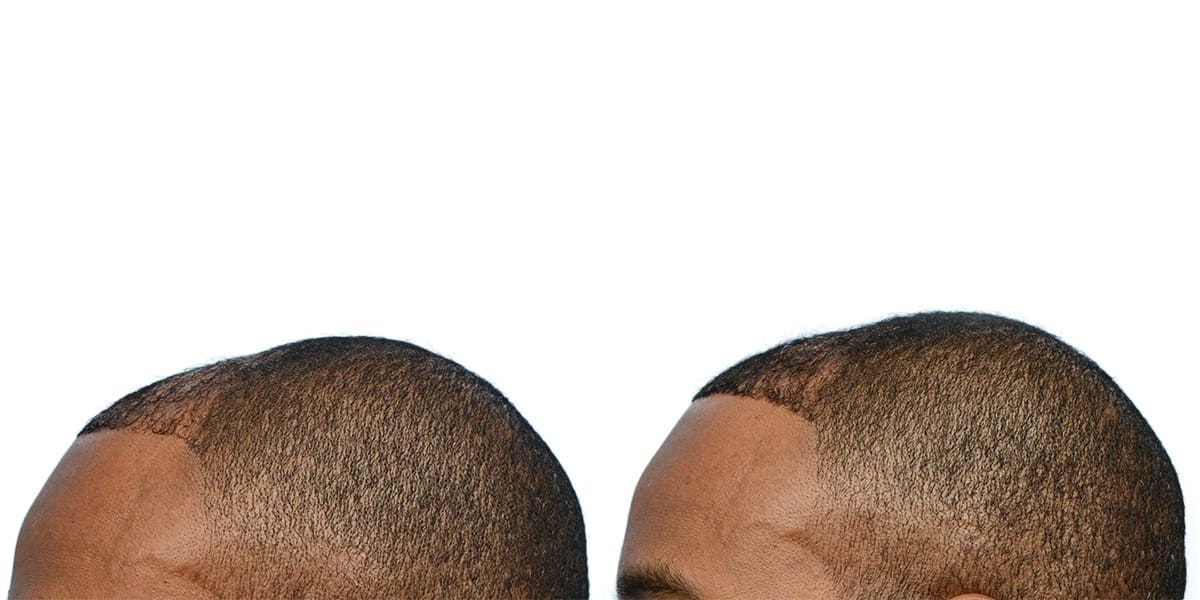 Hair Restoration Before & After Gallery - Patient 211907 - Image 5