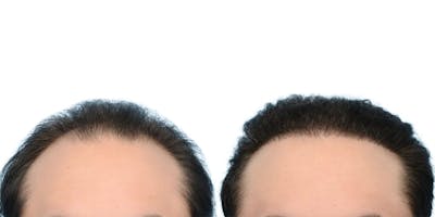Platelet-Rich-Plasma Before & After Gallery - Patient 335821 - Image 1