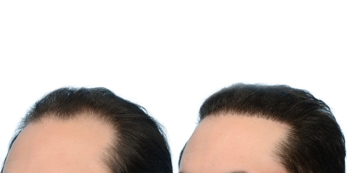 Hair Restoration Before & After Gallery - Patient 229154 - Image 2