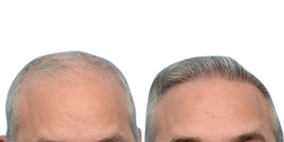 FUE Hair Transplant Before & After Gallery - Patient 671588 - Image 1