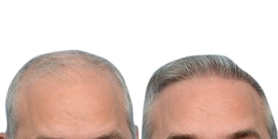 FUE Hair Transplant Before & After Gallery - Patient 671588 - Image 1