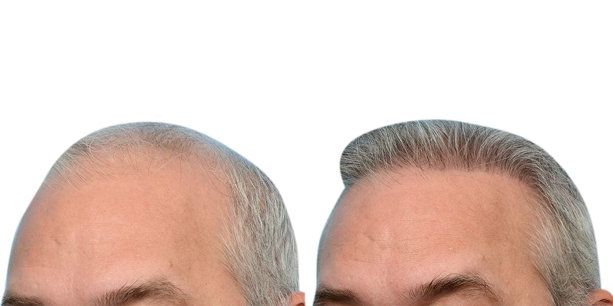 FUE Hair Transplant Before & After Gallery - Patient 671588 - Image 2