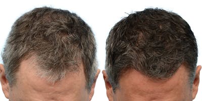 Hair Restoration Before & After Gallery - Patient 142117 - Image 1