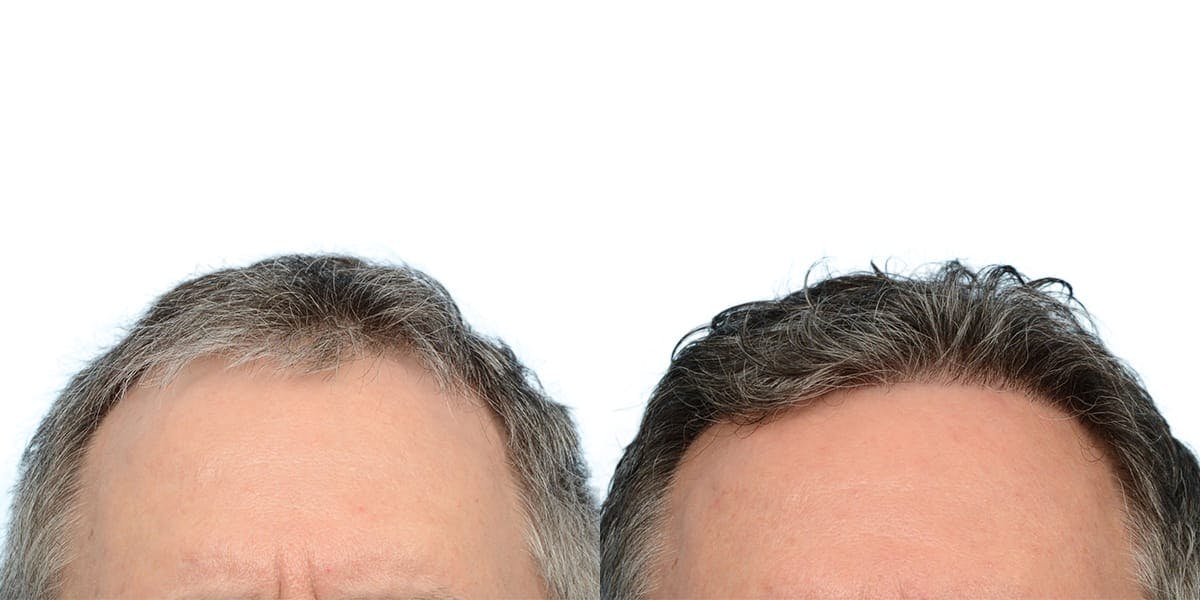 FUE Hair Transplant Before & After Gallery - Patient 395298 - Image 2