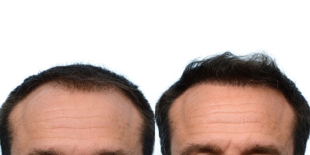 FUE Hair Transplant Before & After Gallery - Patient 340632 - Image 2