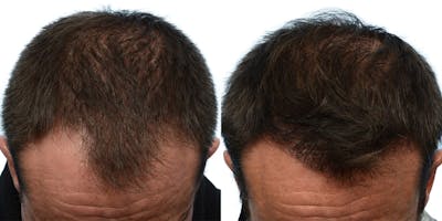 FUE Hair Transplant Before & After Gallery - Patient 340632 - Image 1