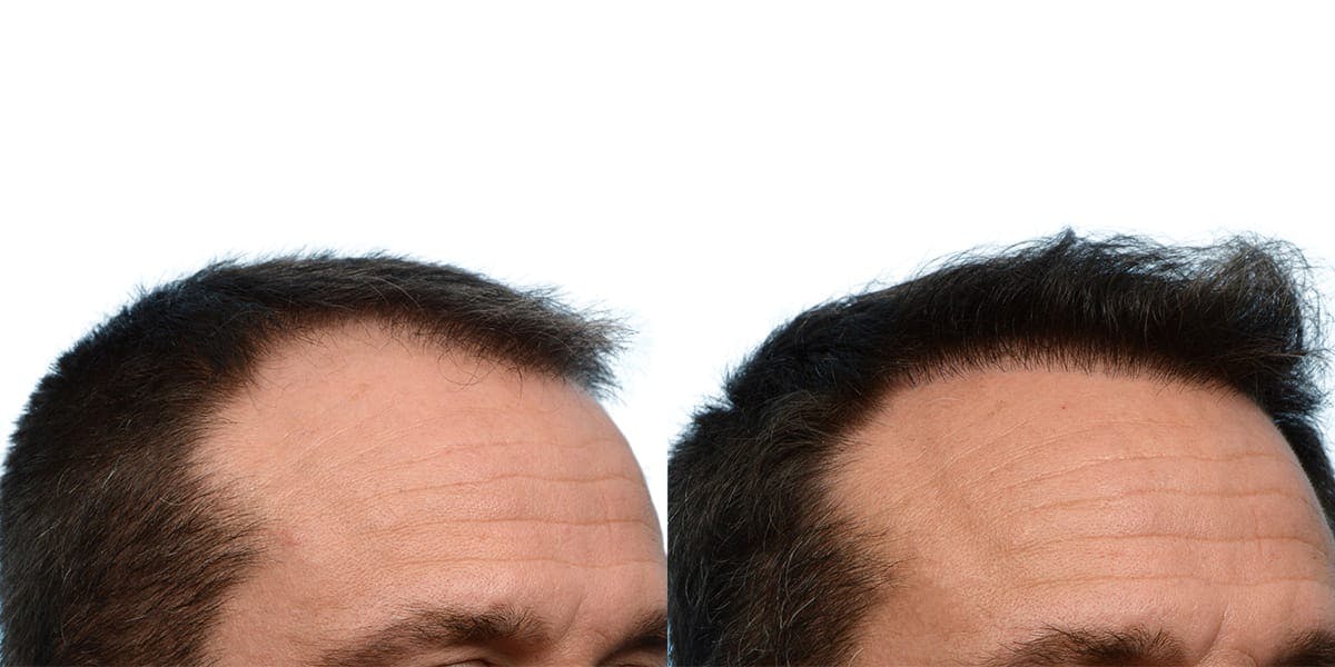 FUE Hair Transplant Before & After Gallery - Patient 340632 - Image 3