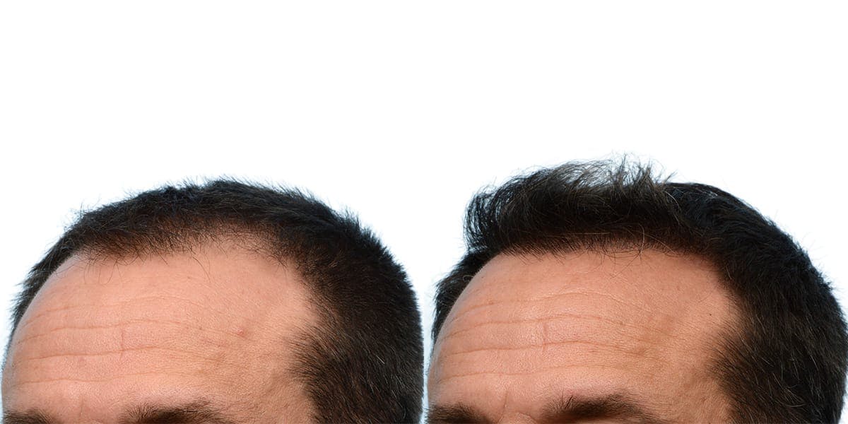 Hair Restoration Before & After Gallery - Patient 246460 - Image 4