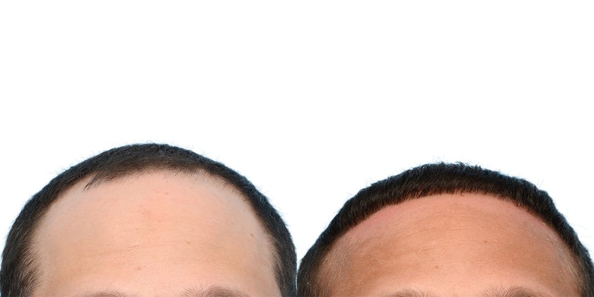 Hair Restoration Before & After Gallery - Patient 340754 - Image 2