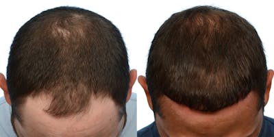Hair Restoration Before & After Gallery - Patient 340754 - Image 1