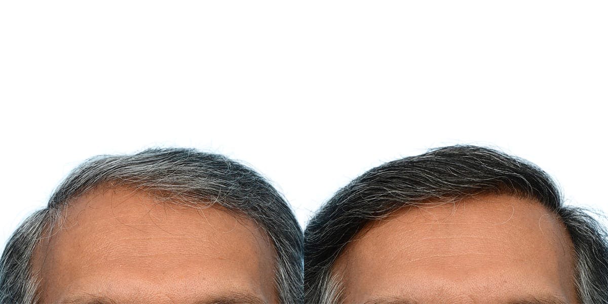 FUE Hair Transplant Before & After Gallery - Patient 384321 - Image 2