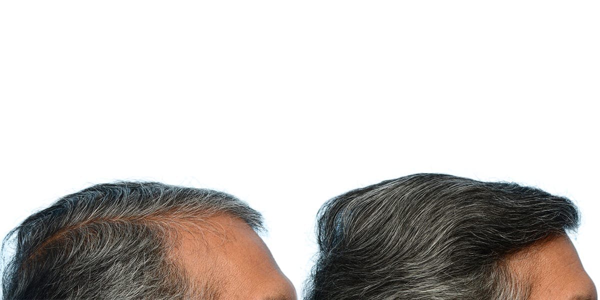 FUE Hair Transplant Before & After Gallery - Patient 384321 - Image 3