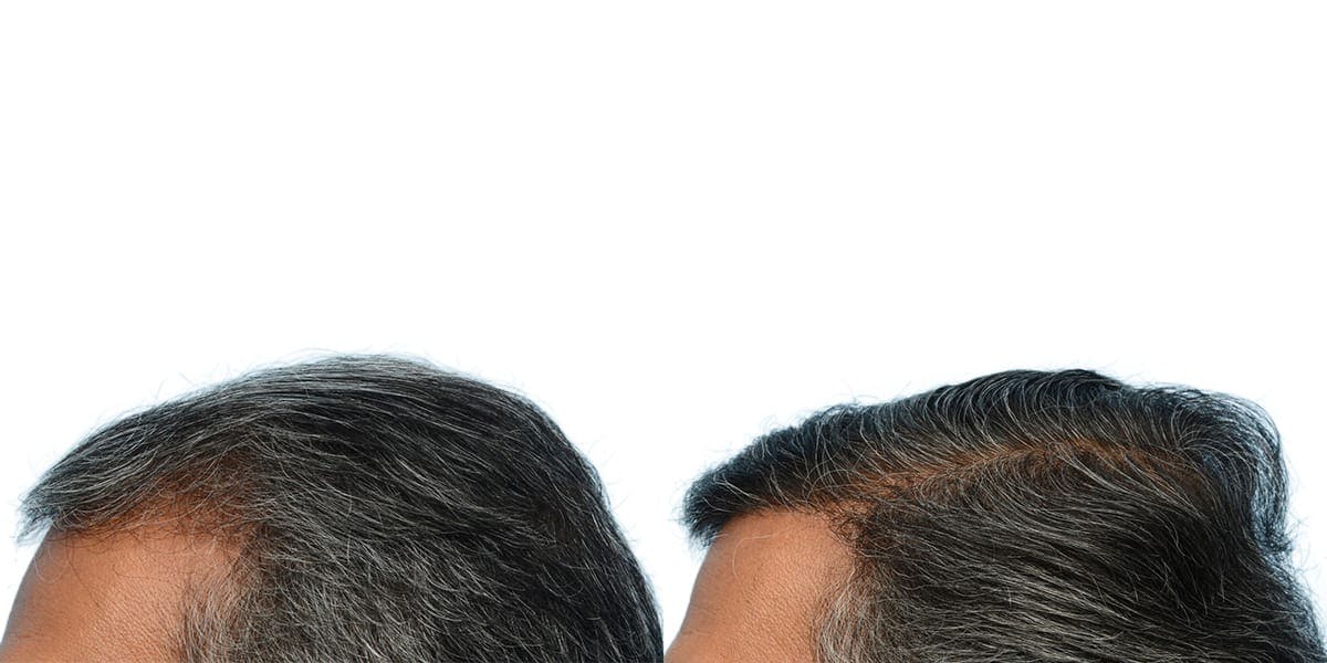 Hair Restoration Before & After Gallery - Patient 266471 - Image 4