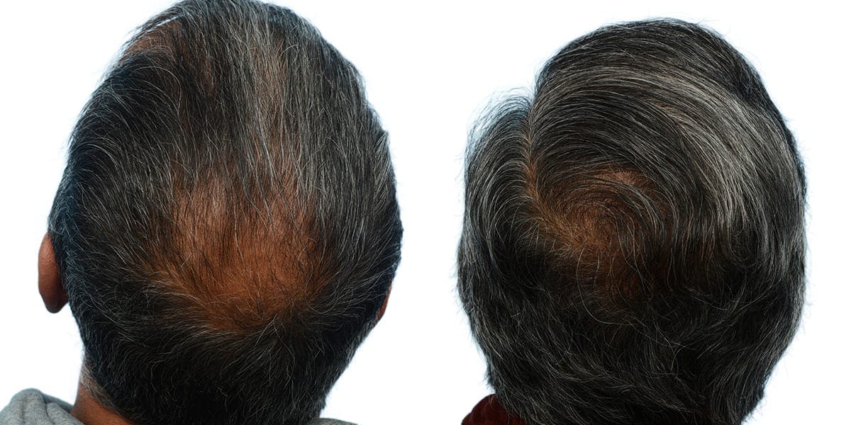 Hair Restoration Before & After Gallery - Patient 266471 - Image 1