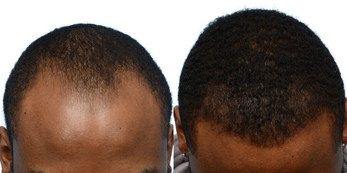 FUE Hair Transplant Before & After Gallery - Patient 196997 - Image 1