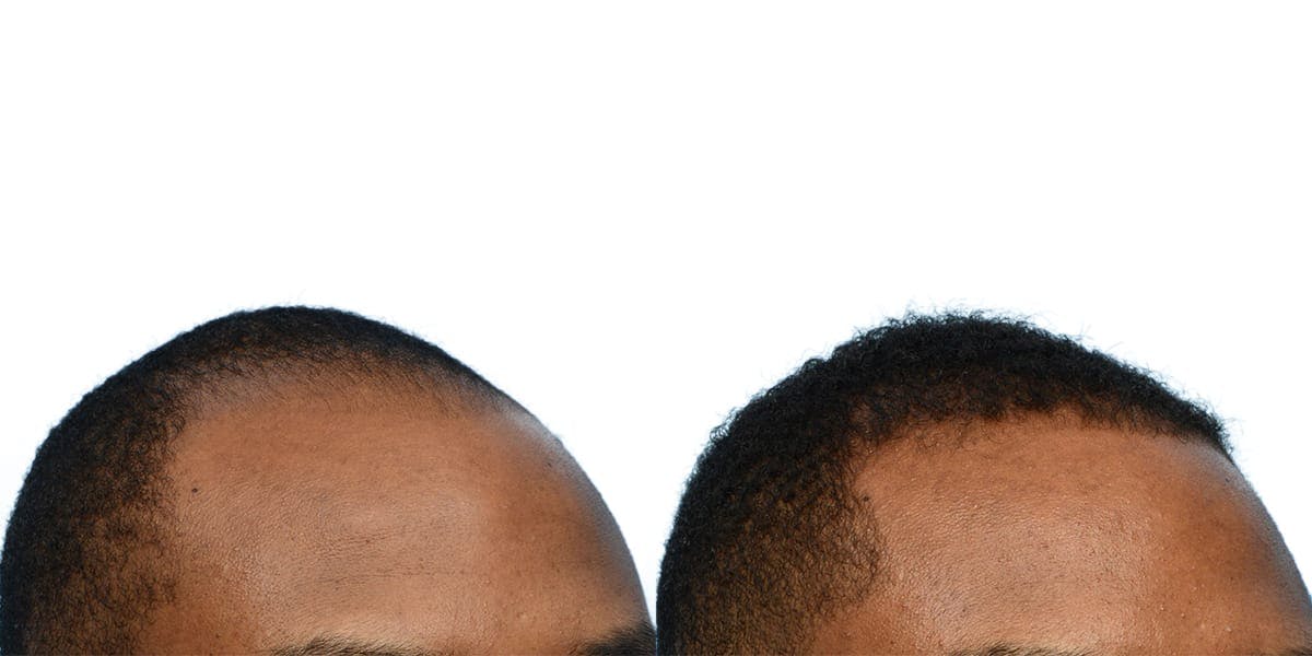 Hair Restoration Before & After Gallery - Patient 370152 - Image 2
