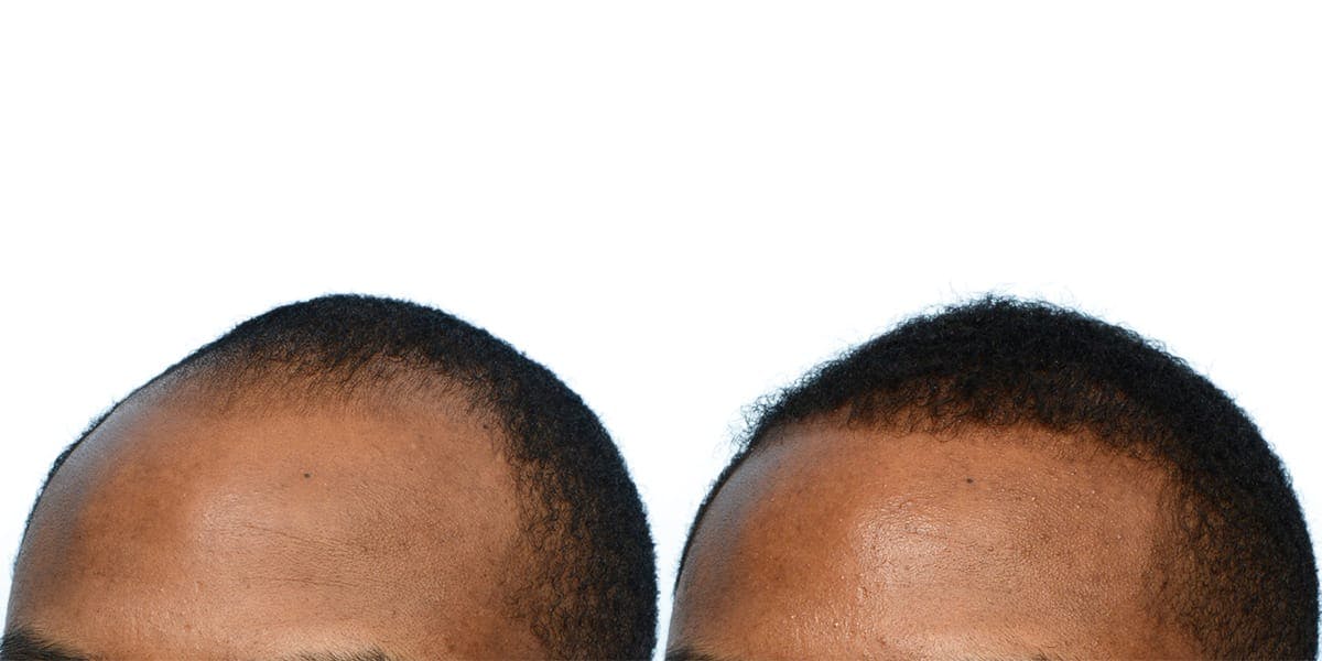 Hair Restoration Before & After Gallery - Patient 370152 - Image 3