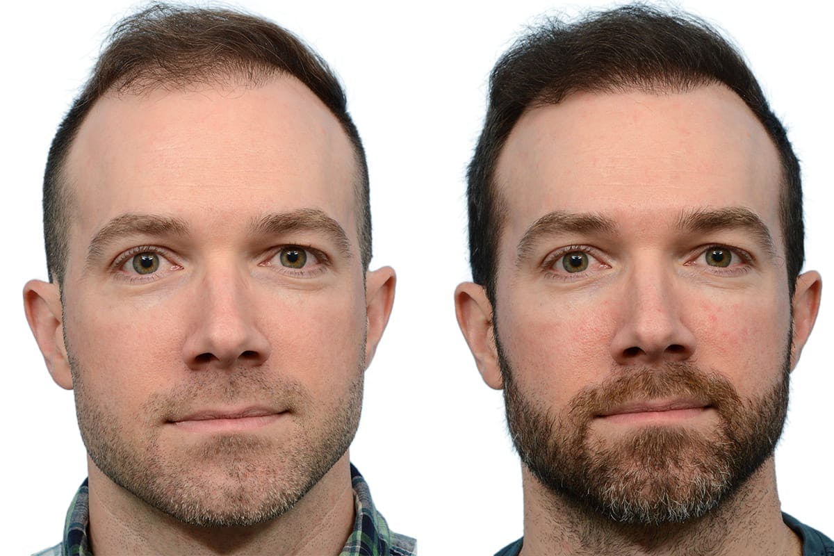 FUE Hair Transplant Before & After Gallery - Patient 122329 - Image 1
