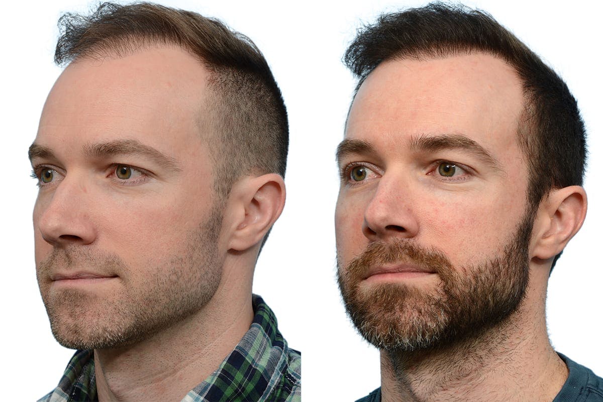 Hair Restoration Before & After Gallery - Patient 206856 - Image 2