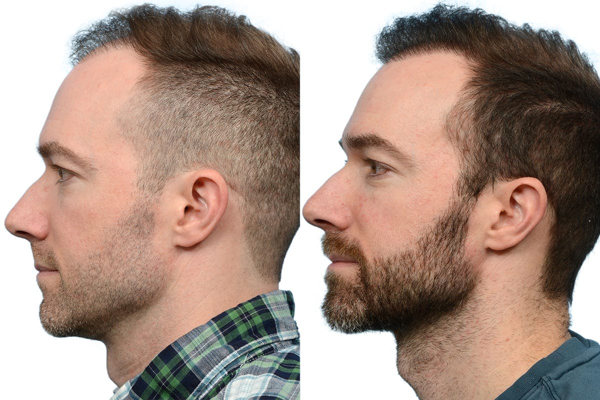Hair Restoration Before & After Gallery - Patient 206856 - Image 3