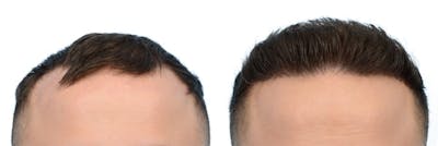 FUE Hair Transplant Before & After Gallery - Patient 416834 - Image 1