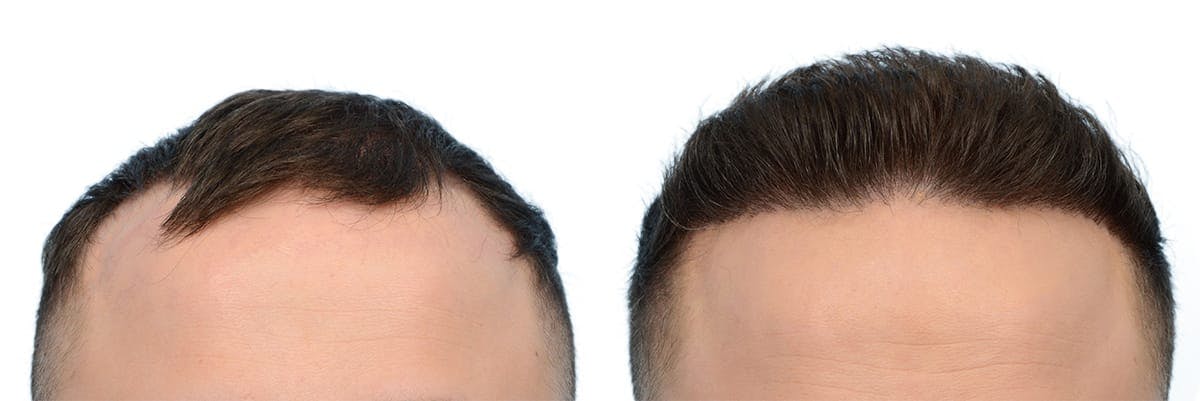 FUE Hair Transplant Before & After Gallery - Patient 416834 - Image 1