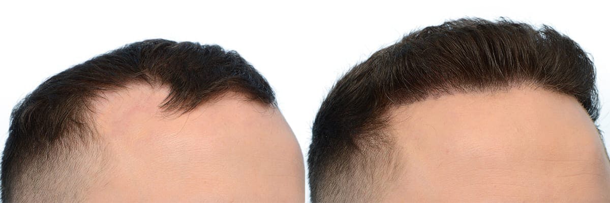 FUE Hair Transplant Before & After Gallery - Patient 416834 - Image 2