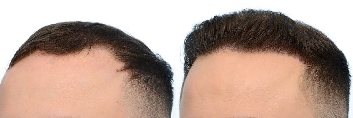 Hair Restoration Before & After Gallery - Patient 246523 - Image 3