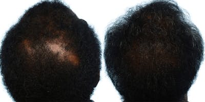 FUT Hair Transplant Before & After Gallery - Patient 286723 - Image 1
