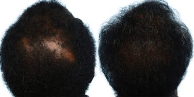 Platelet-Rich-Plasma Before & After Gallery - Patient 116599 - Image 1