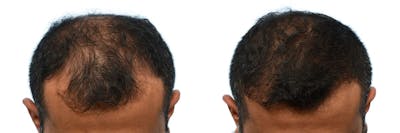 Hair Restoration Before & After Gallery - Patient 274349 - Image 1