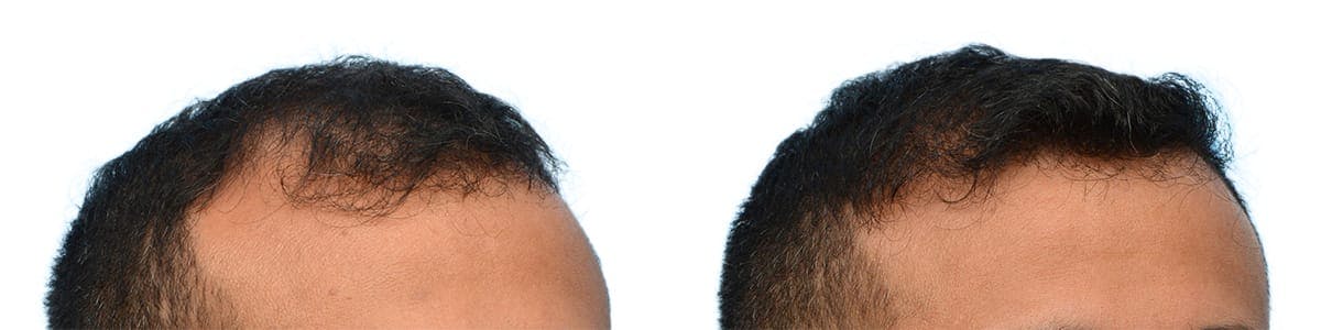 FUE Hair Transplant Before & After Gallery - Patient 317089 - Image 2