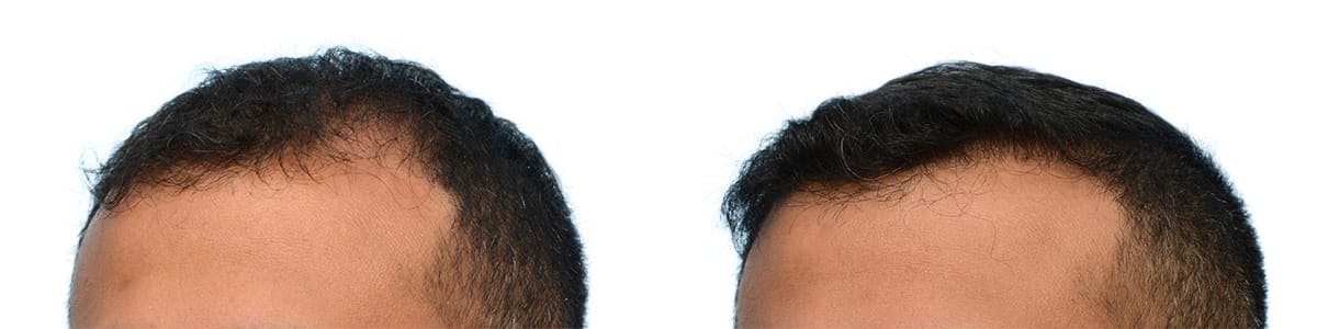 FUE Hair Transplant Before & After Gallery - Patient 317089 - Image 3