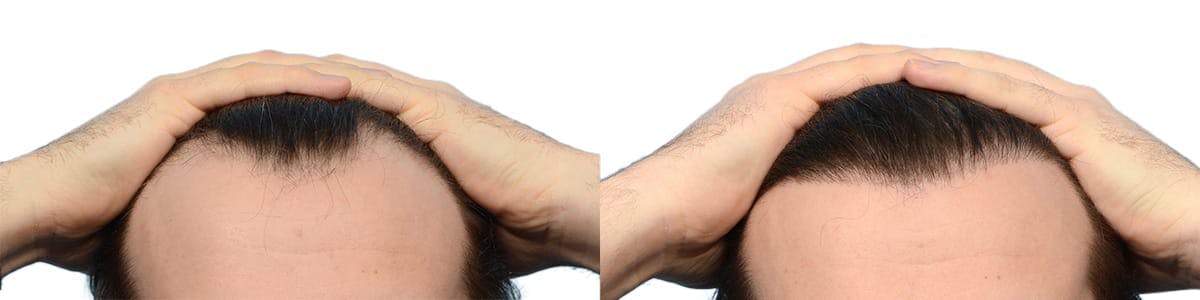 FUE Hair Transplant Before & After Gallery - Patient 250882 - Image 1