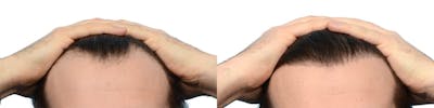 Platelet-Rich-Plasma Before & After Gallery - Patient 265729 - Image 1