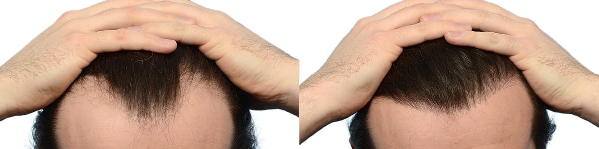 FUE Hair Transplant Before & After Gallery - Patient 250882 - Image 2