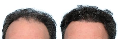 Hair Restoration Before & After Gallery - Patient 339432 - Image 1