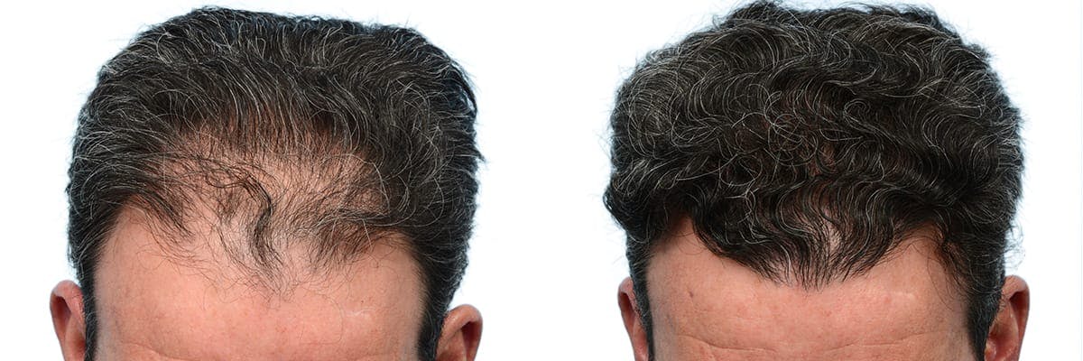 Hair Restoration Before & After Gallery - Patient 339432 - Image 2