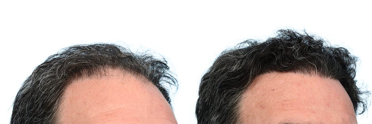 Hair Restoration Before & After Gallery - Patient 339432 - Image 3