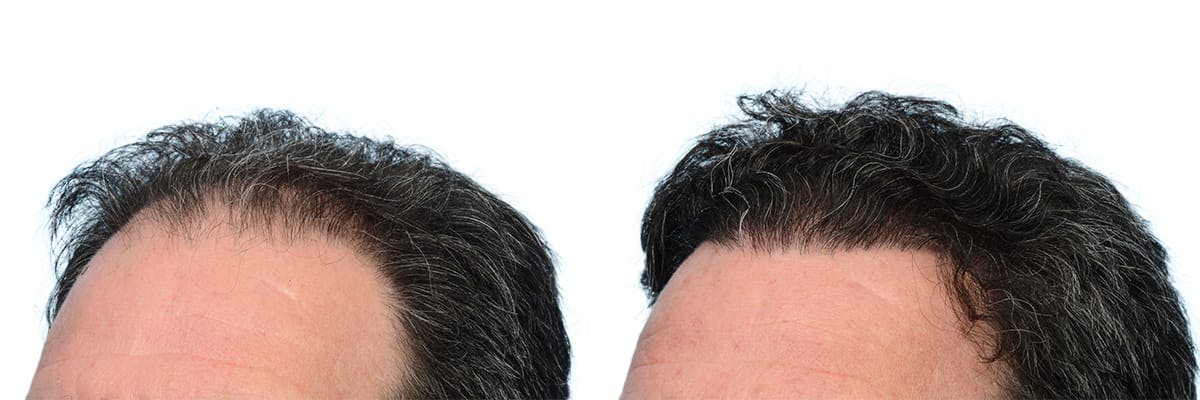 Hair Restoration Before & After Gallery - Patient 339432 - Image 4
