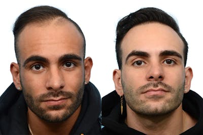 FUE Hair Transplant Before & After Gallery - Patient 705314 - Image 1