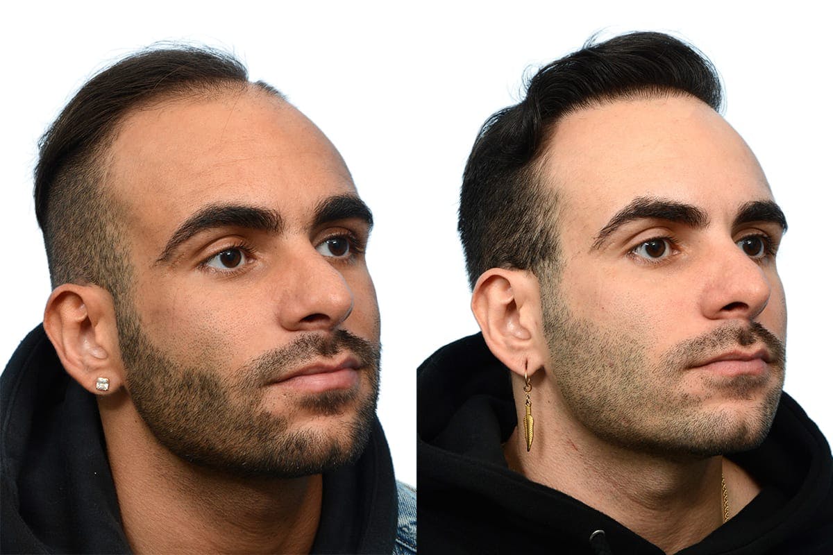 Hair Restoration Before & After Gallery - Patient 412654 - Image 2