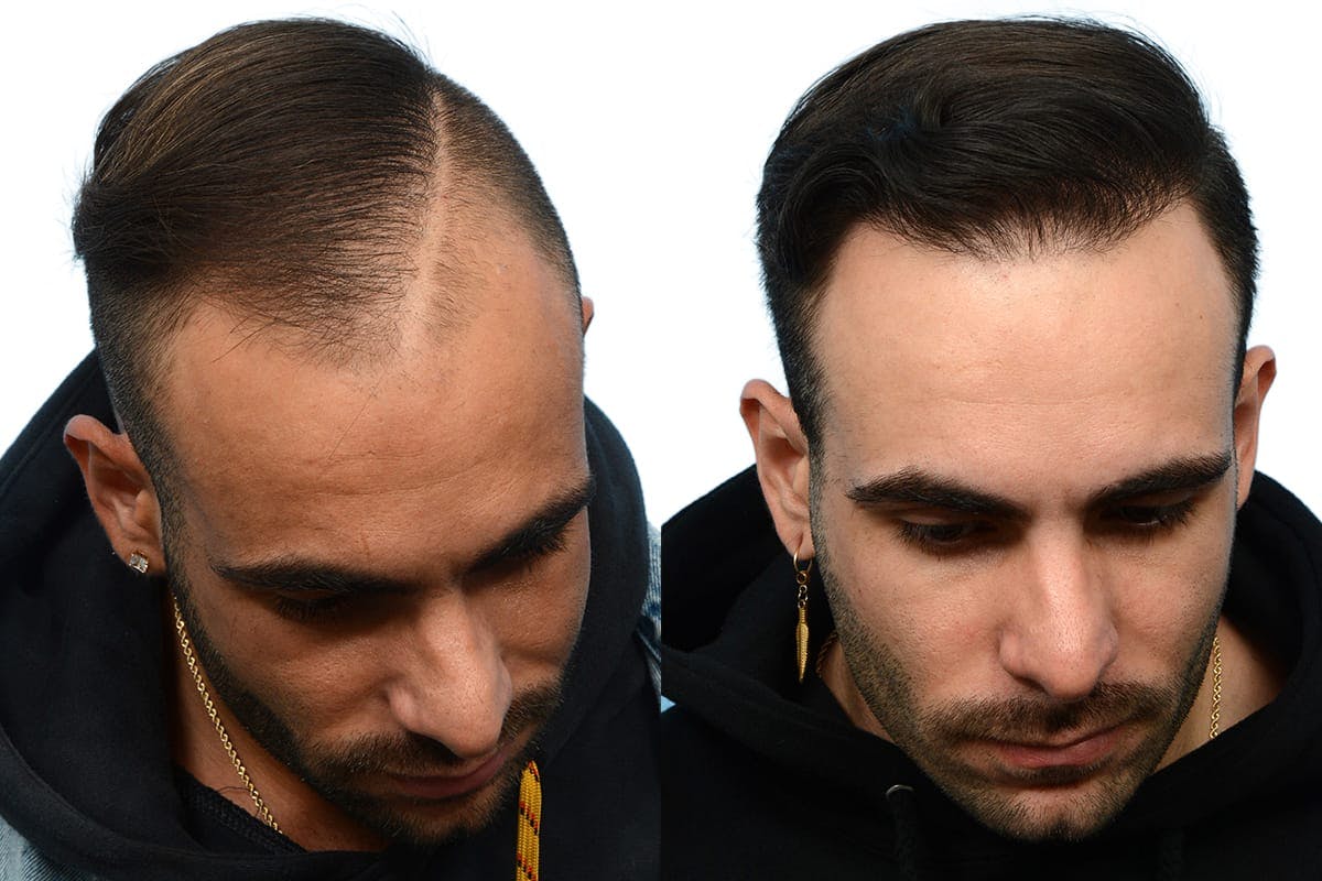 FUE Hair Transplant Before & After Gallery - Patient 705314 - Image 3