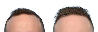 FUE Hair Transplant Before & After Gallery - Patient 125408 - Image 1