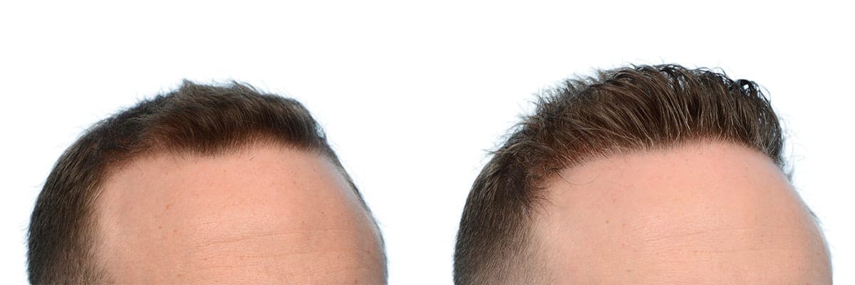 FUE Hair Transplant Before & After Gallery - Patient 125408 - Image 2