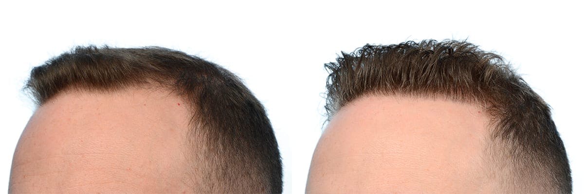FUE Hair Transplant Before & After Gallery - Patient 125408 - Image 3