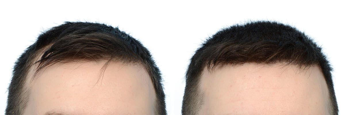 FUE Hair Transplant Before & After Gallery - Patient 172625 - Image 1