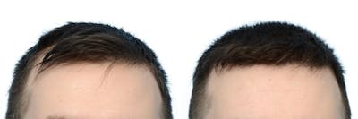 FUE Hair Transplant Before & After Gallery - Patient 172625 - Image 1