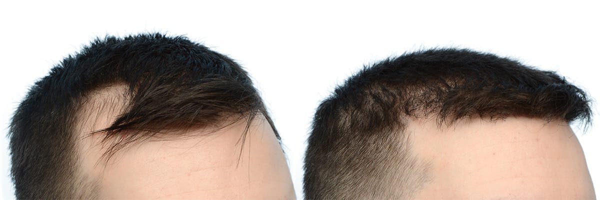 FUE Hair Transplant Before & After Gallery - Patient 172625 - Image 2